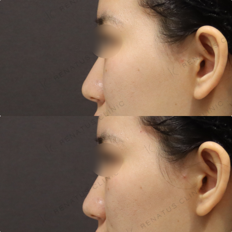 鼻翼基部ヒアルロン酸症例 鼻翼基部ヒアルロン酸症例