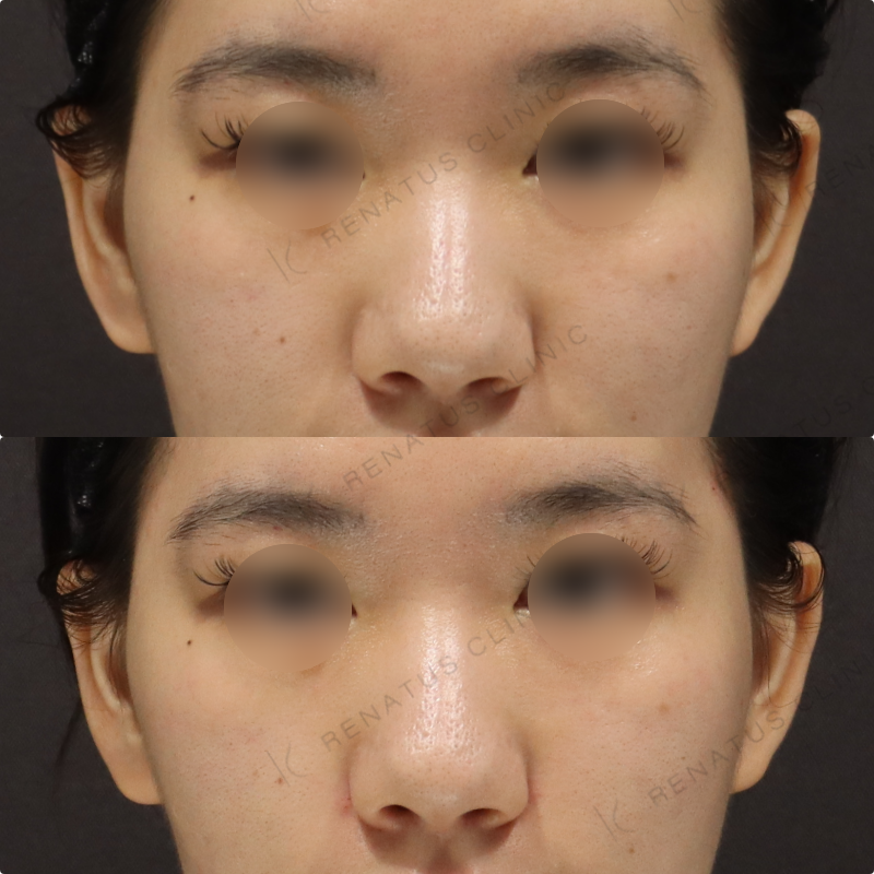 鼻翼基部ヒアルロン酸症例写真 鼻翼基部ヒアルロン酸症例