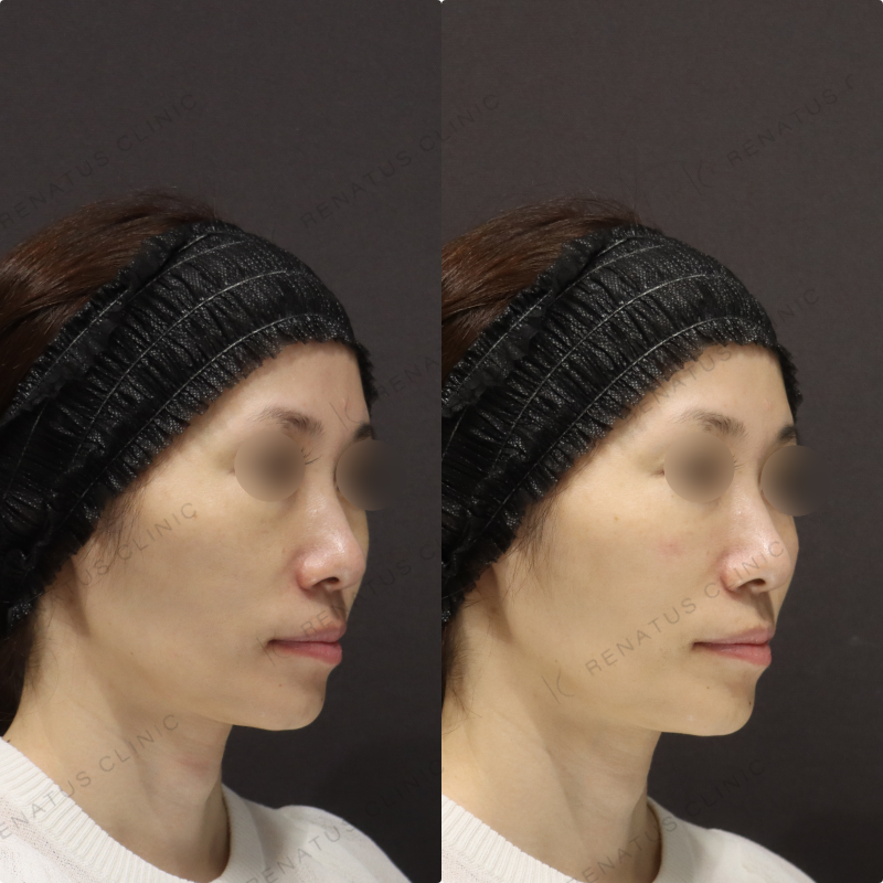 ゴルゴラインヒアルロン酸 ゴルゴラインヒアルロン酸