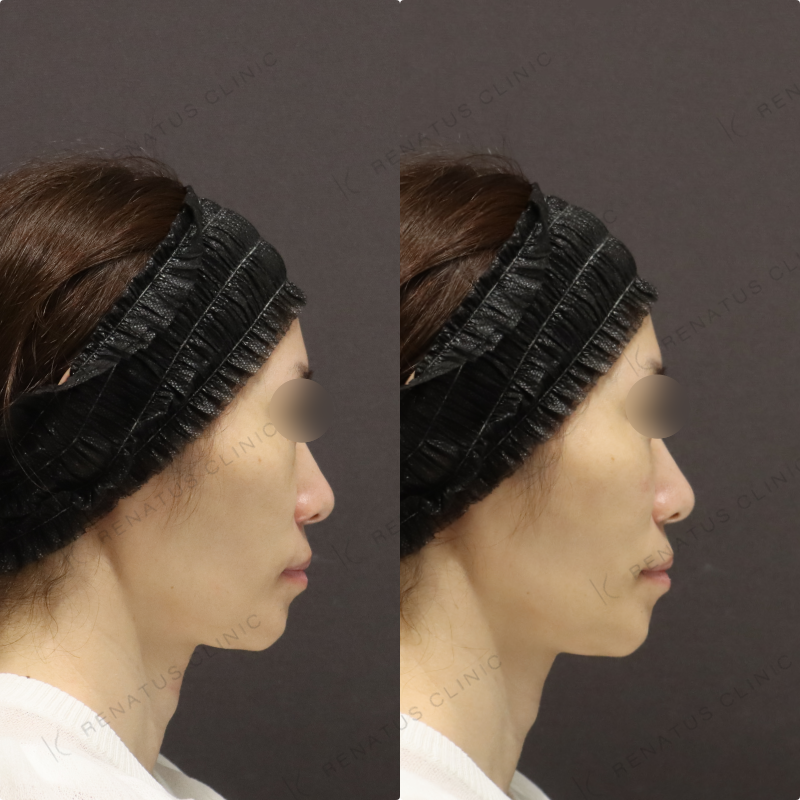 ゴルゴラインヒアルロン酸 ゴルゴラインヒアルロン酸