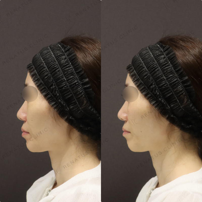 ゴルゴラインヒアルロン酸症例写真 ゴルゴラインヒアルロン酸