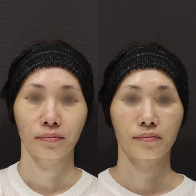 ゴルゴラインヒアルロン酸 ゴルゴラインヒアルロン酸