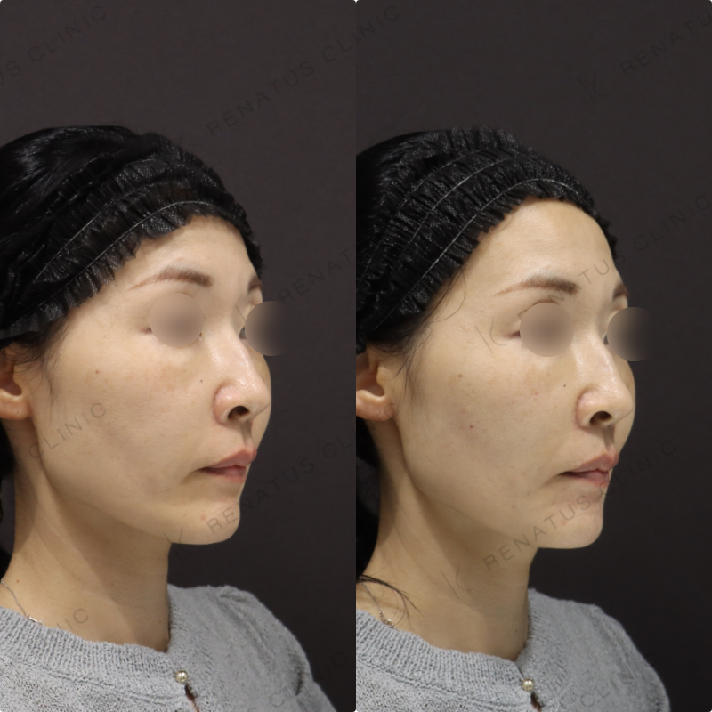 顎・リフトアップヒアルロン酸症例写真 顎・リフトアップヒアルロン酸症例写真