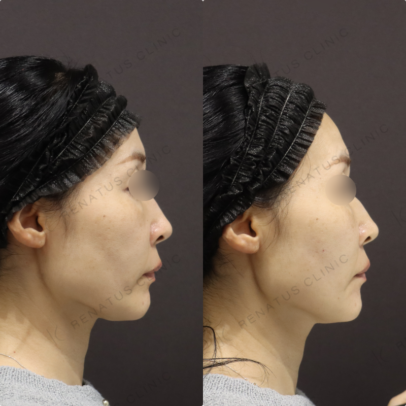 顎・リフトアップヒアルロン酸症例写真 顎・リフトアップヒアルロン酸症例写真