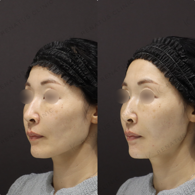 顎・リフトアップヒアルロン酸症例写真 顎・リフトアップヒアルロン酸症例写真