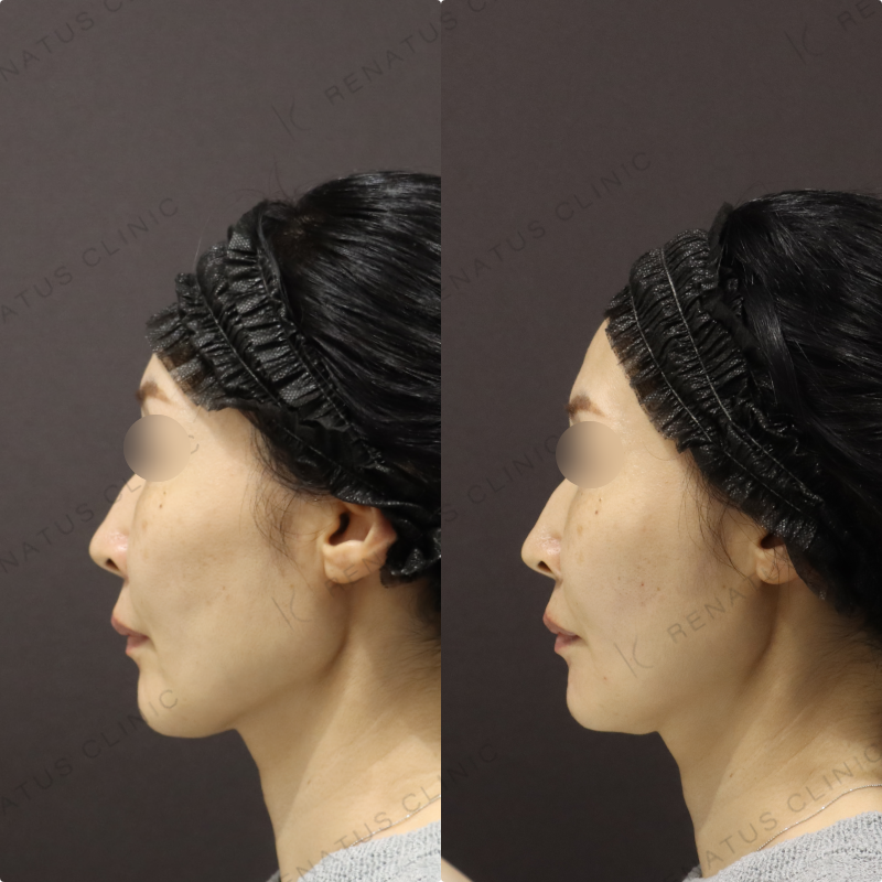 顎・リフトアップヒアルロン酸症例写真 顎・リフトアップヒアルロン酸症例写真