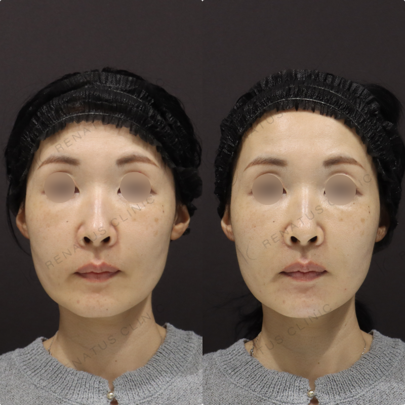 顎・リフトアップヒアルロン酸症例写真 顎・リフトアップヒアルロン酸症例写真