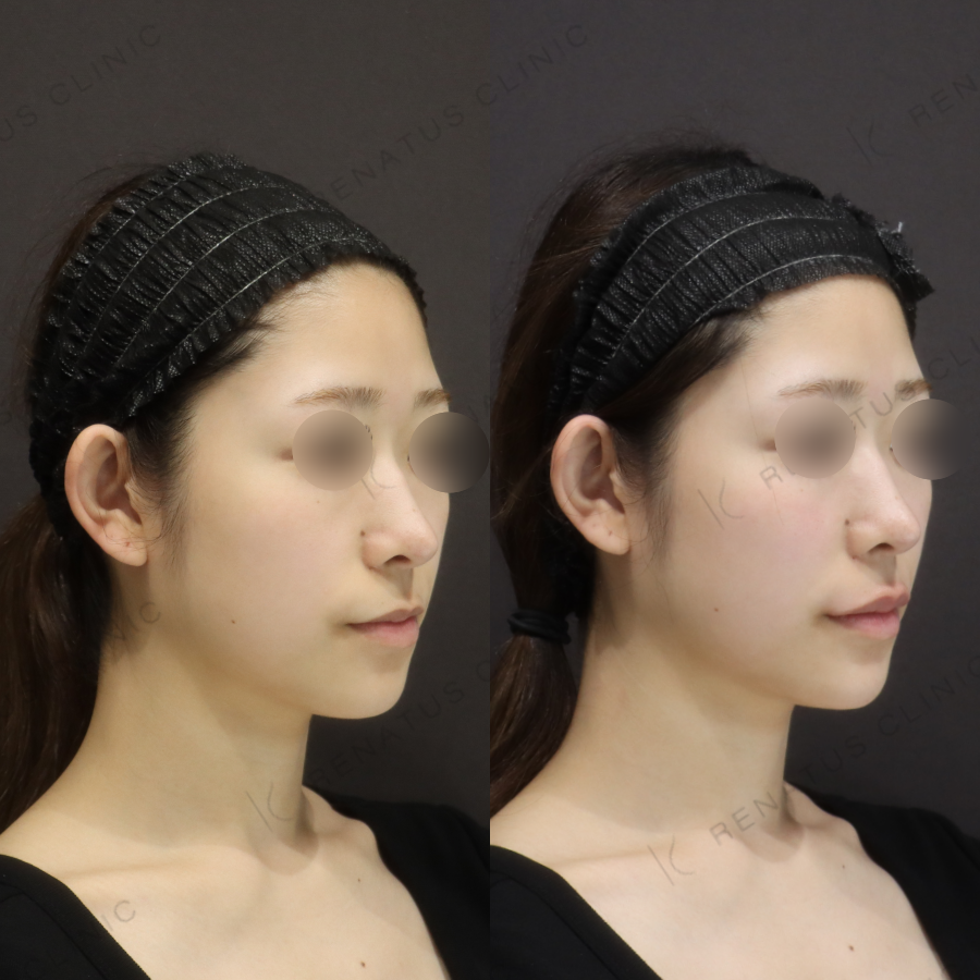 唇・顎ヒアルロン酸症例写真 唇・顎ヒアルロン酸症例写真