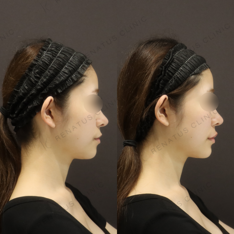 唇・顎ヒアルロン酸症例写真 唇・顎ヒアルロン酸症例写真