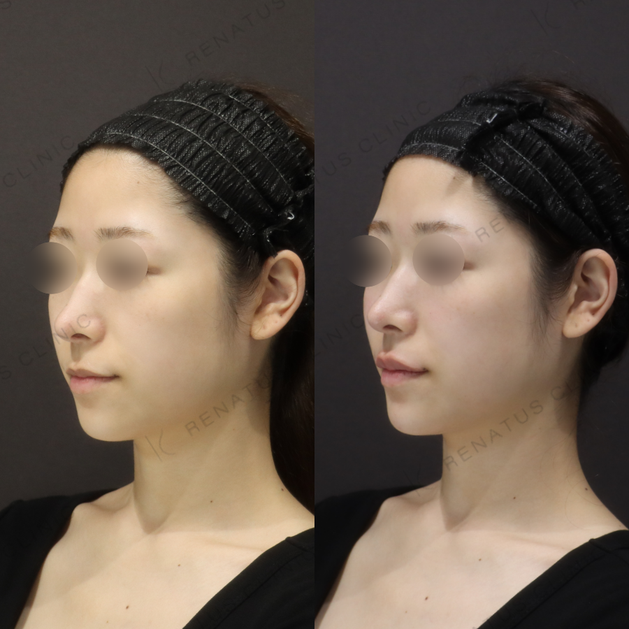 唇・顎ヒアルロン酸症例写真 唇・顎ヒアルロン酸症例写真