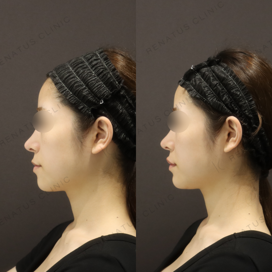 唇・顎ヒアルロン酸症例写真 唇・顎ヒアルロン酸症例写真