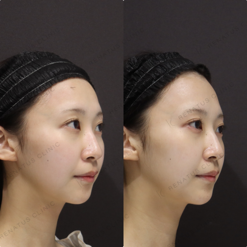 涙袋ヒアルロン酸症例写真 涙袋ヒアルロン酸症例写真