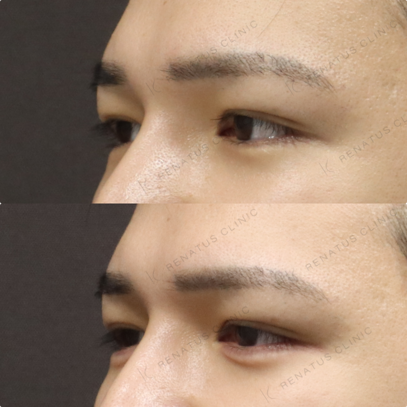 涙袋ヒアルロン酸症例写真 涙袋ヒアルロン酸症例写真