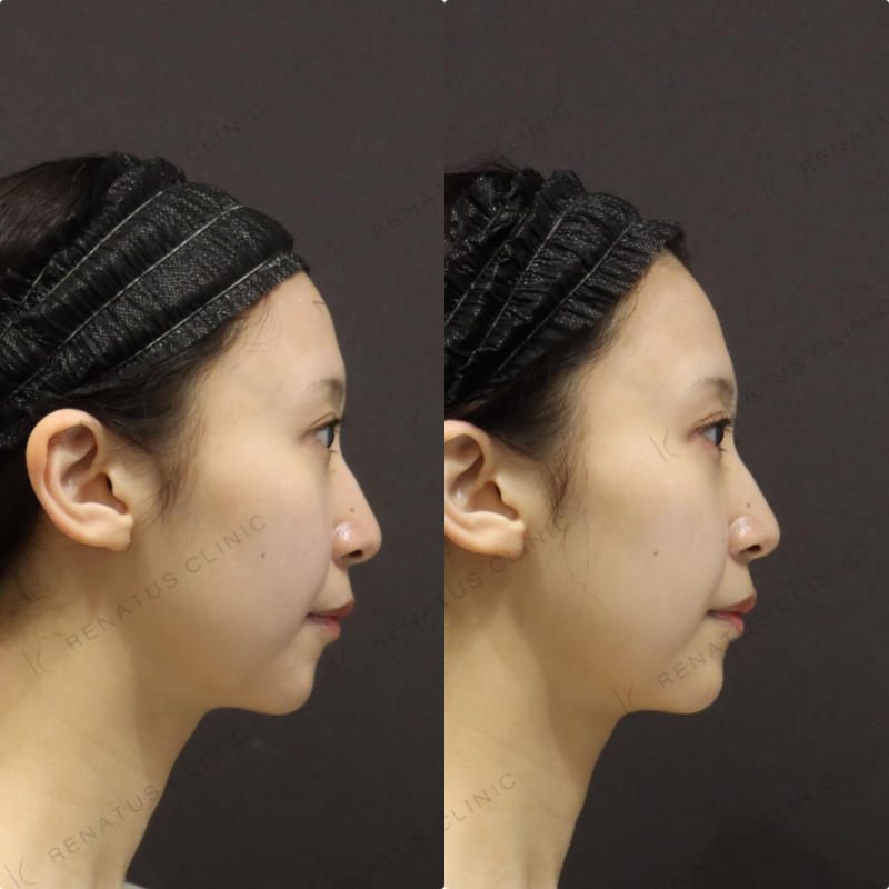 涙袋ヒアルロン酸症例写真 涙袋ヒアルロン酸症例写真