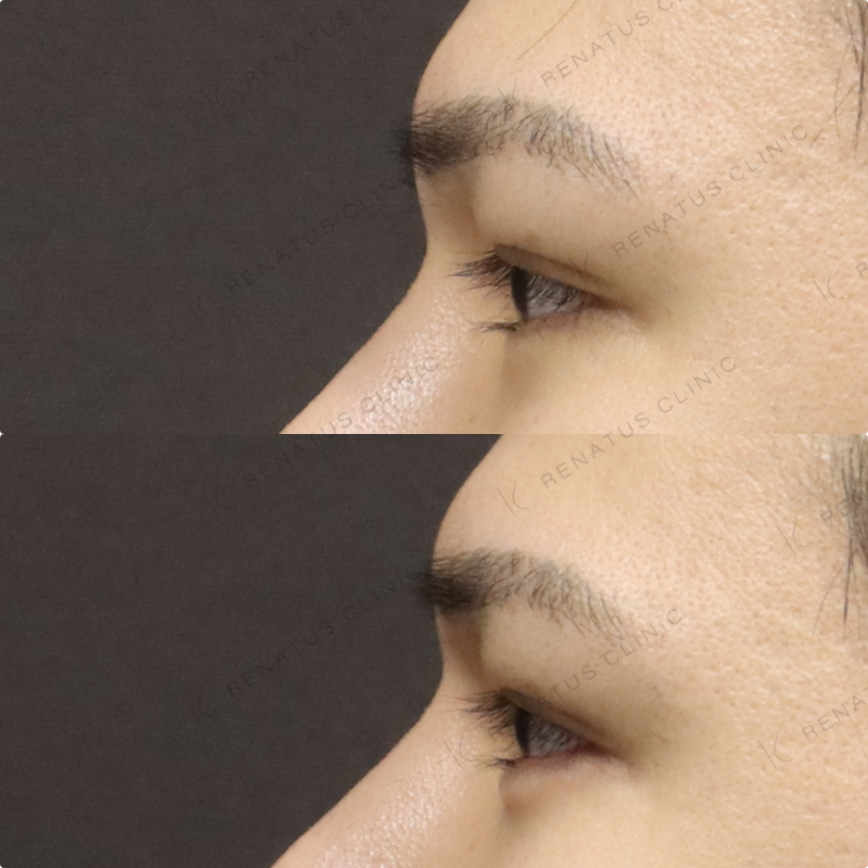 涙袋ヒアルロン酸症例写真 涙袋ヒアルロン酸症例写真