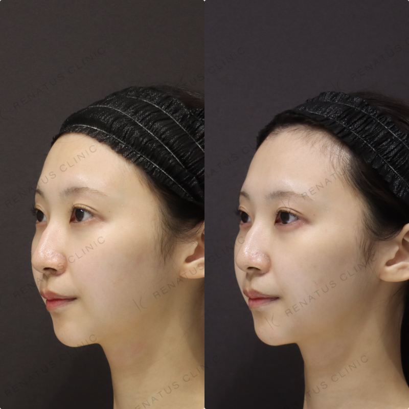 涙袋ヒアルロン酸症例写真 涙袋ヒアルロン酸症例写真