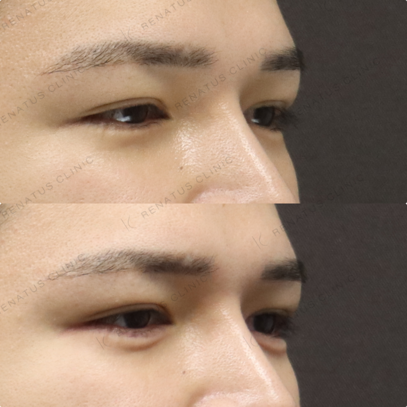 涙袋ヒアルロン酸症例写真 涙袋ヒアルロン酸症例写真