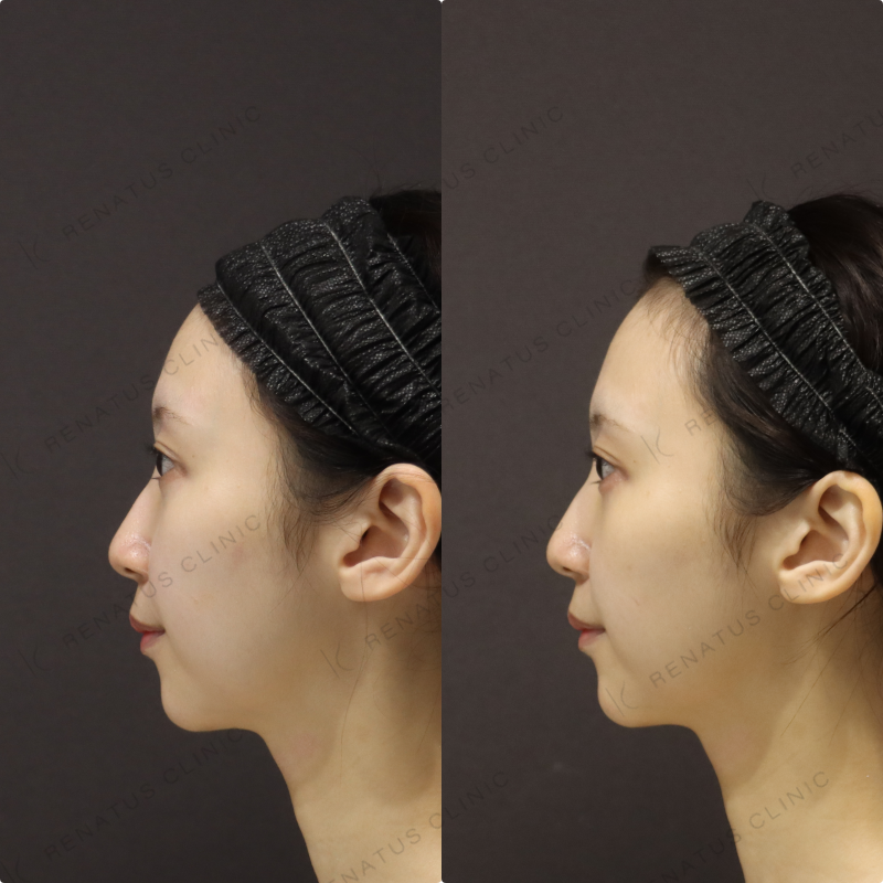 涙袋ヒアルロン酸症例写真 涙袋ヒアルロン酸症例写真