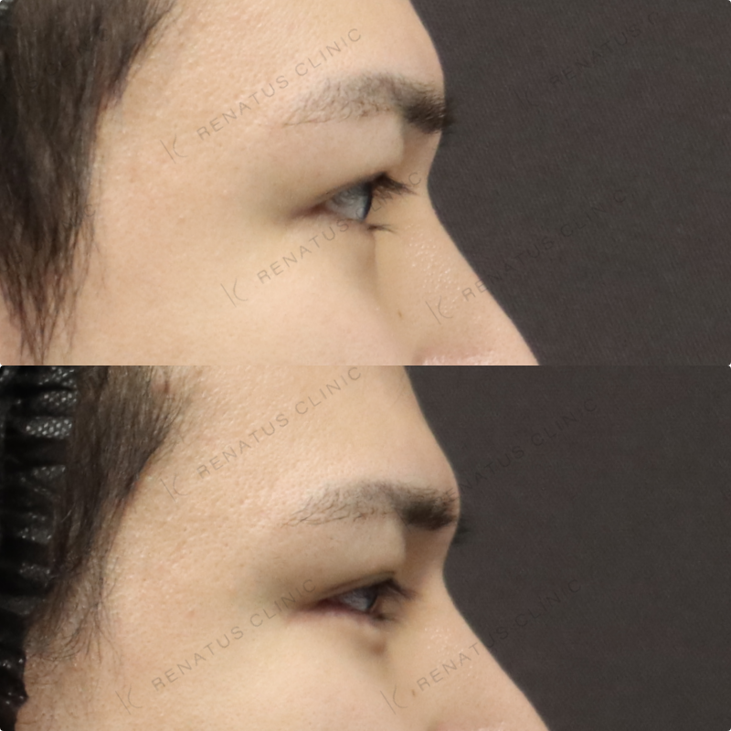 涙袋ヒアルロン酸症例写真 涙袋ヒアルロン酸症例写真