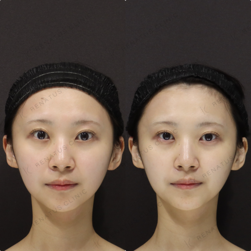 涙袋ヒアルロン酸症例写真 涙袋ヒアルロン酸症例写真