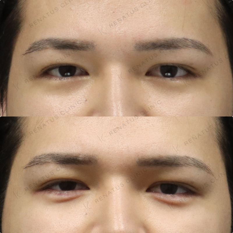 涙袋ヒアルロン酸症例写真 涙袋ヒアルロン酸症例写真