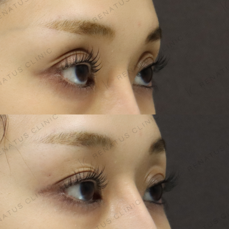 目の上ヒアルロン酸症例写真 目の上ヒアルロン酸症例写真