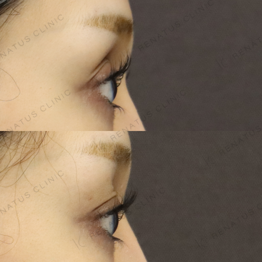 目の上ヒアルロン酸症例写真 目の上ヒアルロン酸症例写真