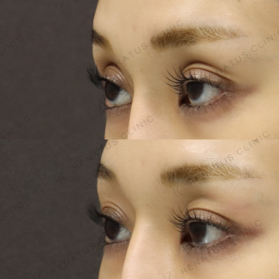 目の上ヒアルロン酸症例写真 目の上ヒアルロン酸症例写真