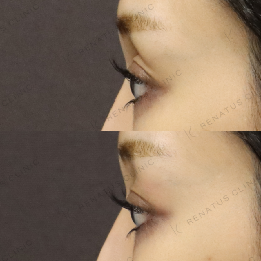 目の上ヒアルロン酸症例写真 目の上ヒアルロン酸症例写真