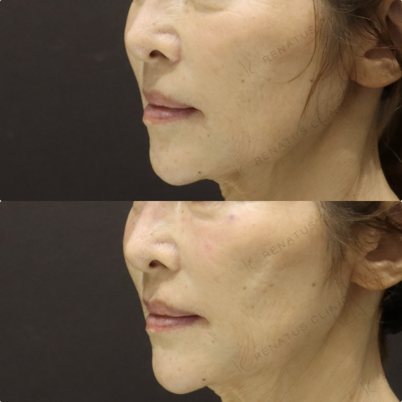 目の下ヒアルロン酸症例写真 目の下ヒアルロン酸症例写真