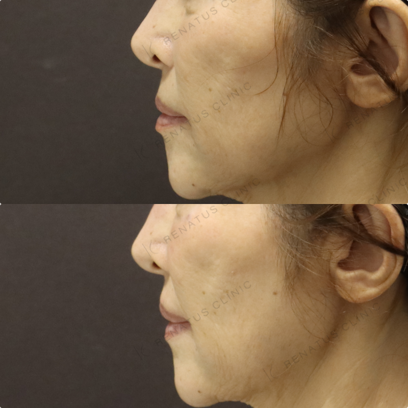 目の下ヒアルロン酸症例写真 目の下ヒアルロン酸症例写真