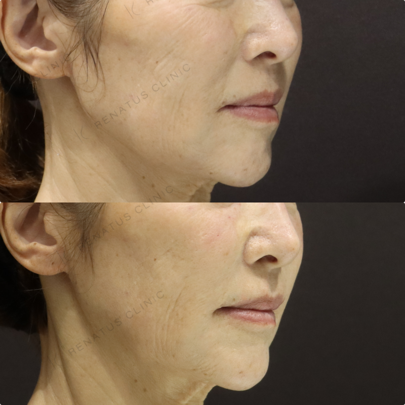 目の下ヒアルロン酸症例写真 目の下ヒアルロン酸症例写真