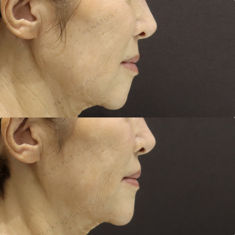 目の下ヒアルロン酸症例写真 目の下ヒアルロン酸症例写真