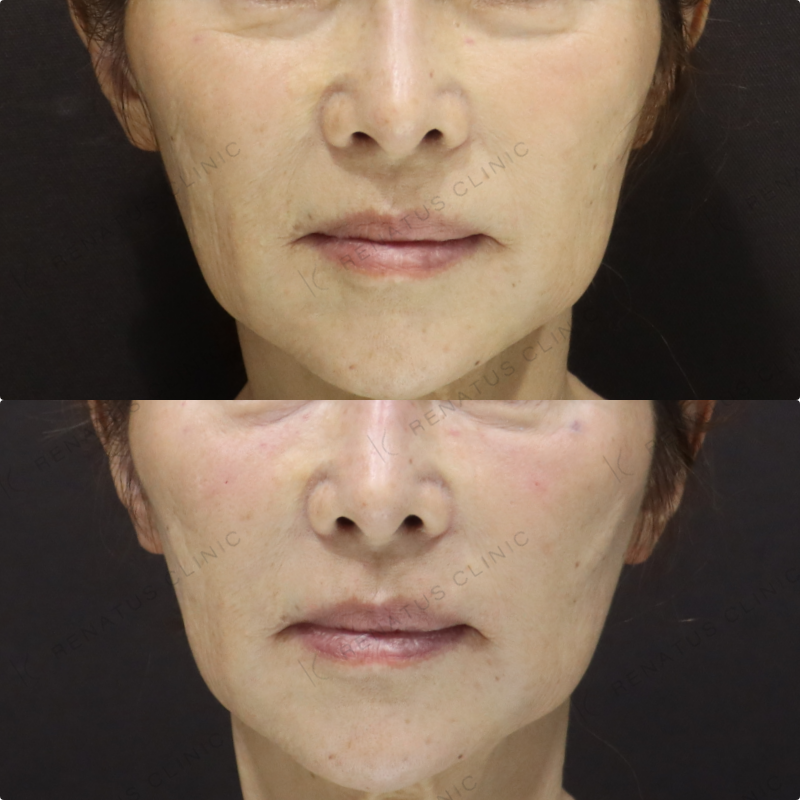 目の下ヒアルロン酸症例写真 目の下ヒアルロン酸症例写真