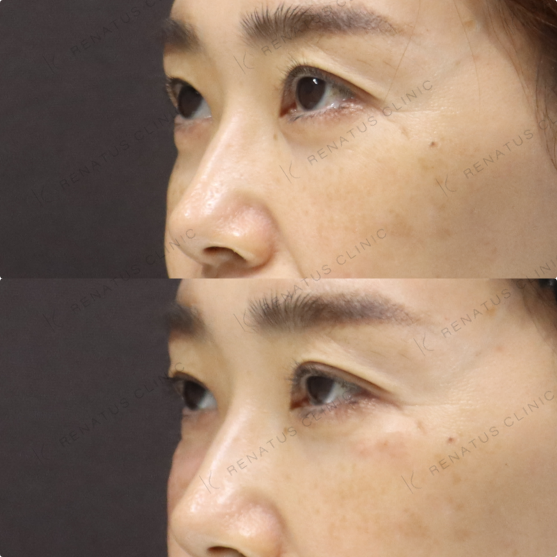 目の下ヒアルロン酸症例写真 目の下ヒアルロン酸症例写真