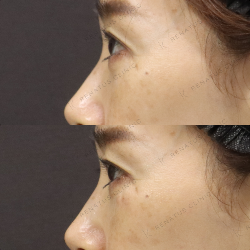 目の下ヒアルロン酸症例写真 目の下ヒアルロン酸症例写真