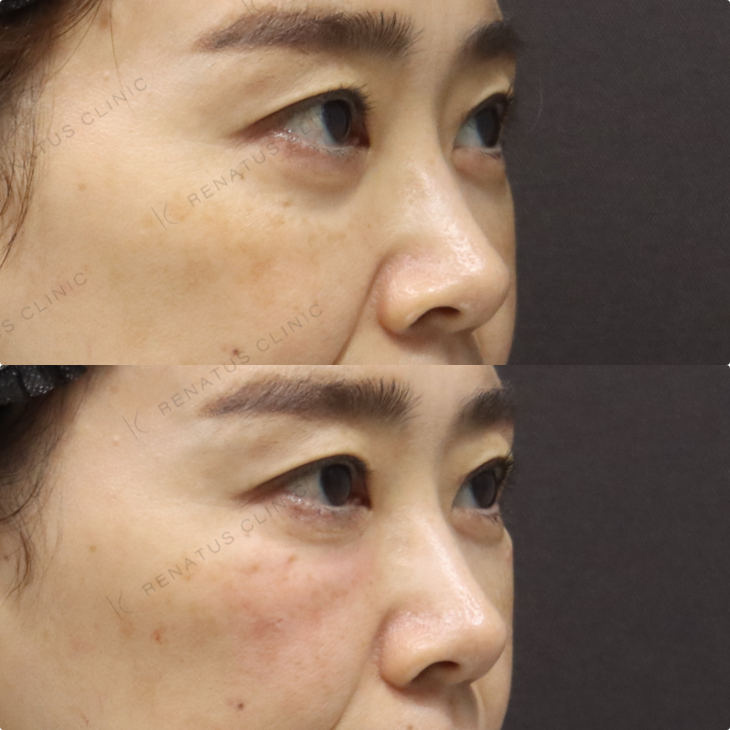 目の下ヒアルロン酸症例写真 目の下ヒアルロン酸症例写真