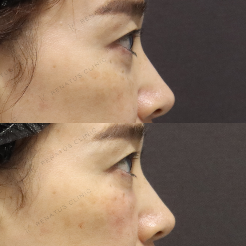 目の下ヒアルロン酸症例写真 目の下ヒアルロン酸症例写真