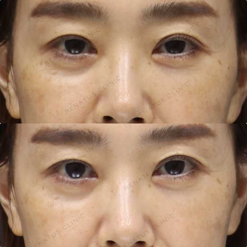 目の下ヒアルロン酸症例写真 目の下ヒアルロン酸症例写真