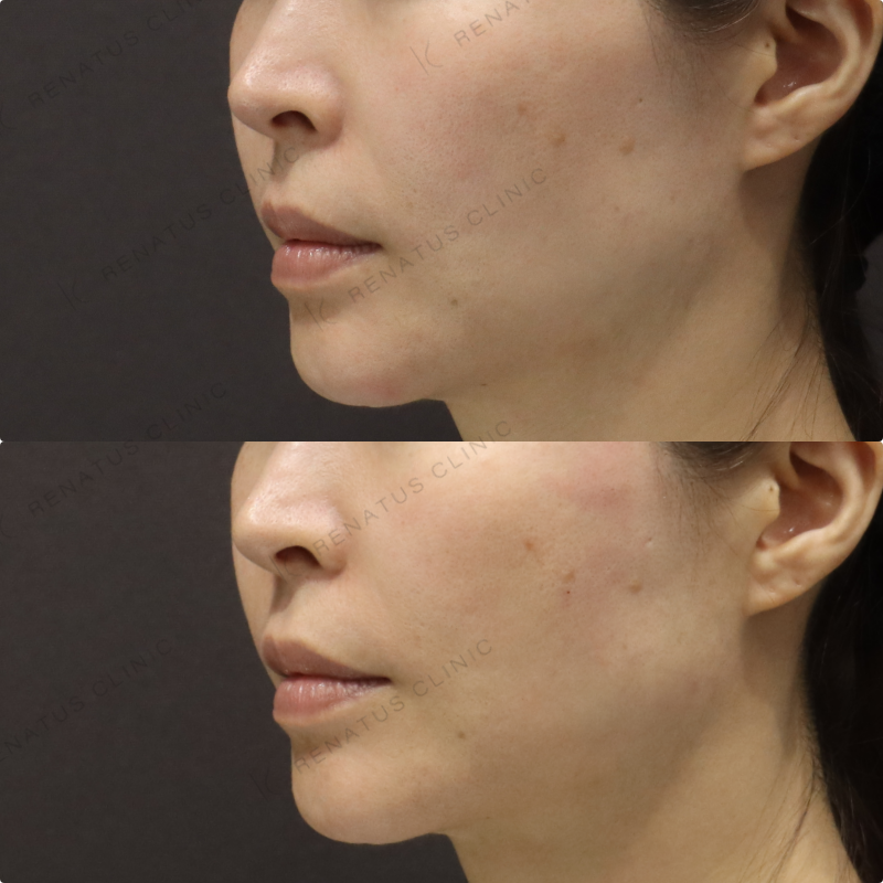 頬ヒアルロン酸症例写真 頬ヒアルロン酸症例写真