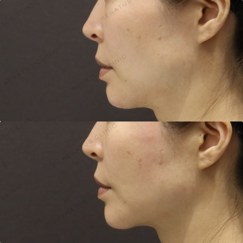 頬ヒアルロン酸症例写真 頬ヒアルロン酸症例写真