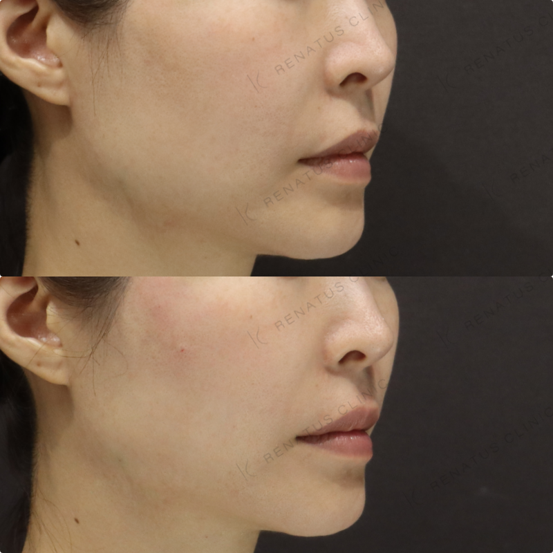 頬ヒアルロン酸症例写真 頬ヒアルロン酸症例写真