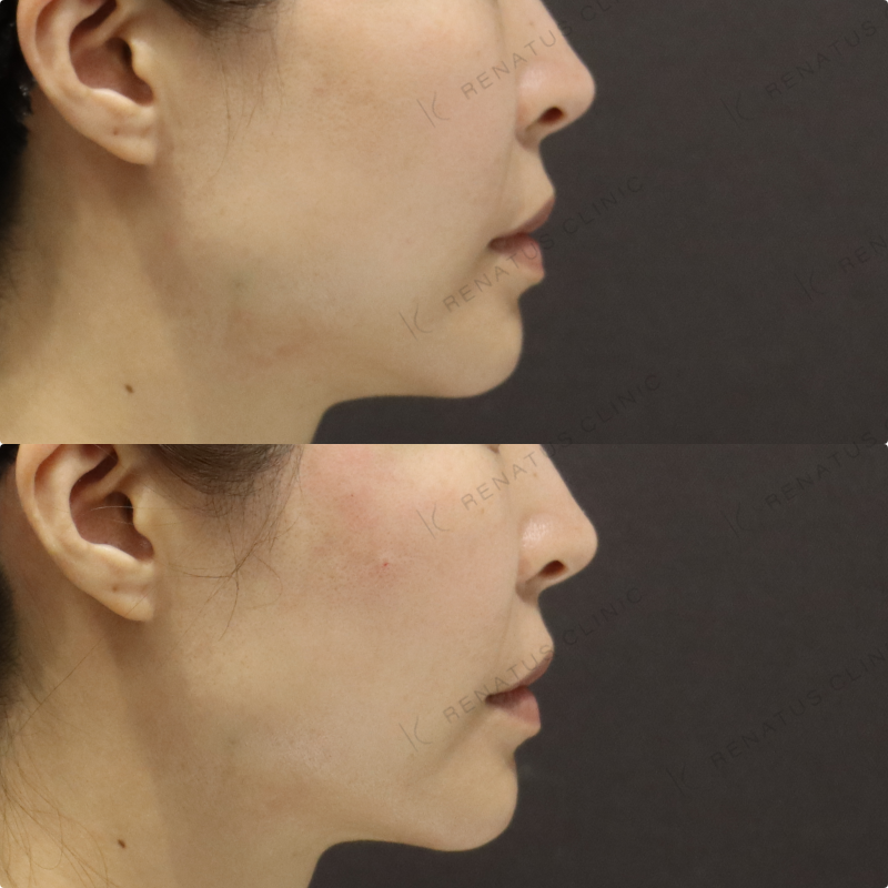 頬ヒアルロン酸症例写真 頬ヒアルロン酸症例写真