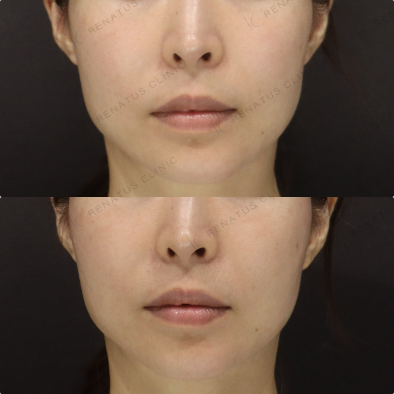 頬ヒアルロン酸症例写真 頬ヒアルロン酸症例写真