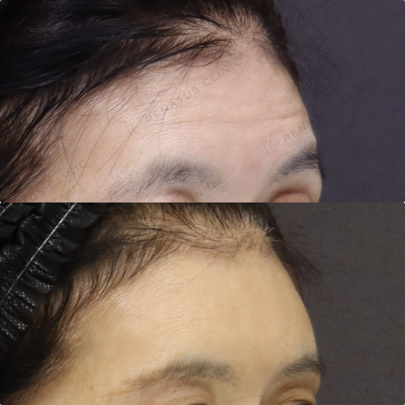 額ヒアルロン酸症例写真 額ヒアルロン酸症例写真