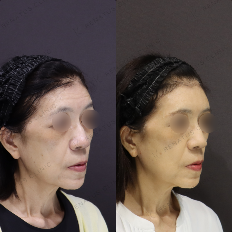 額ヒアルロン酸症例写真 額ヒアルロン酸症例写真