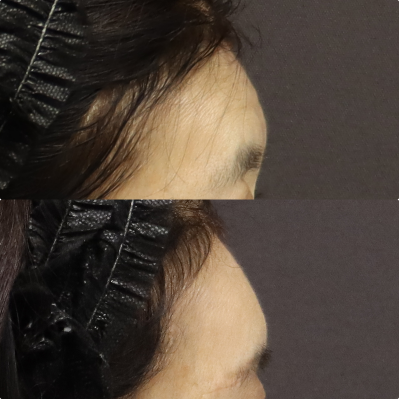 額ヒアルロン酸症例写真 額ヒアルロン酸症例写真