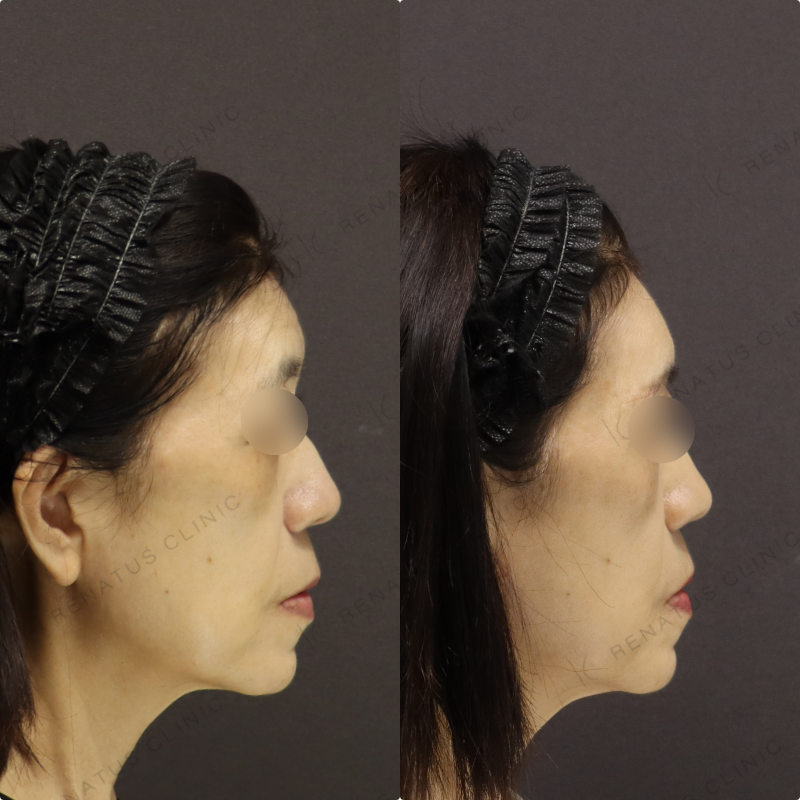 額ヒアルロン酸症例写真 額ヒアルロン酸症例写真