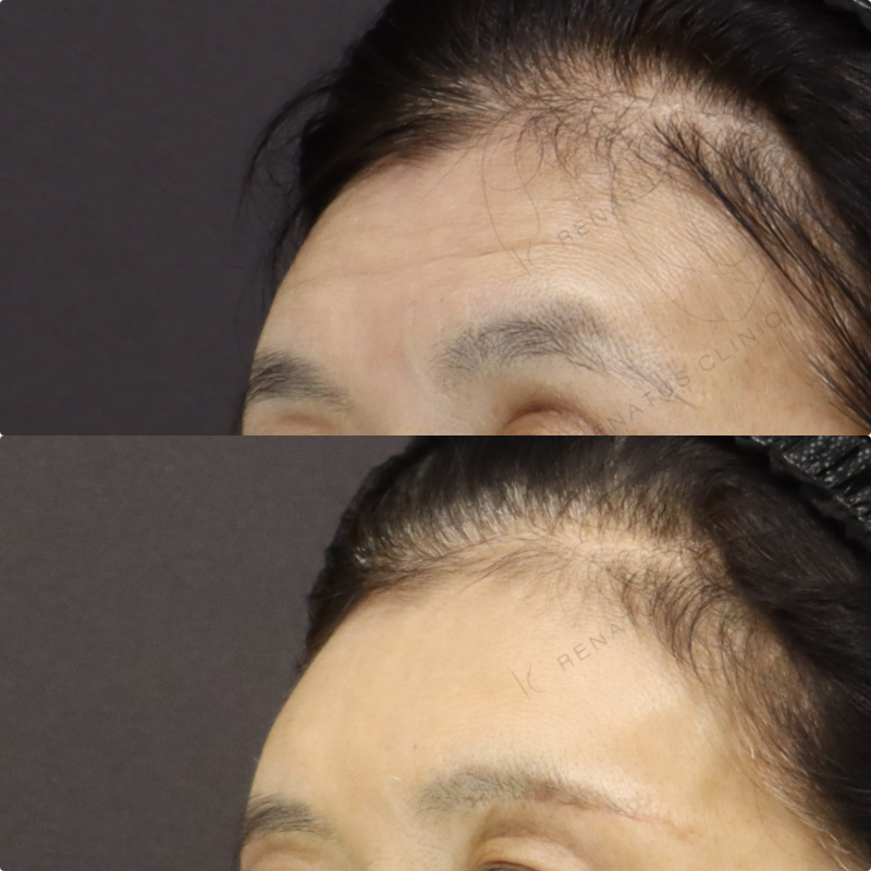 額ヒアルロン酸症例写真 額ヒアルロン酸症例写真