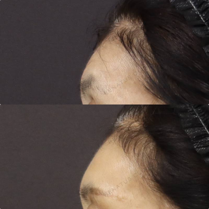 額ヒアルロン酸症例写真 額ヒアルロン酸症例写真